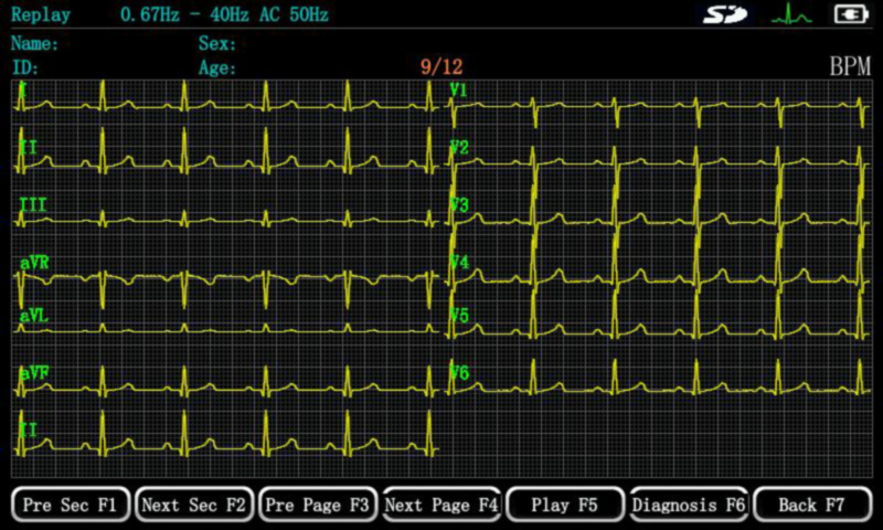ECG Waveform Freezing and Review